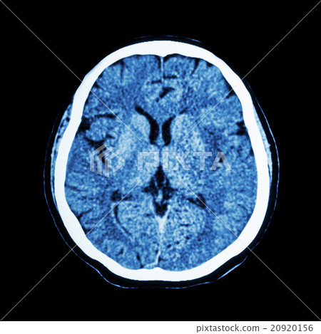 CT scan of brain CT scan of brain 20920156