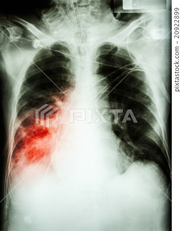 Pneumonia with respiratory failure 20922899