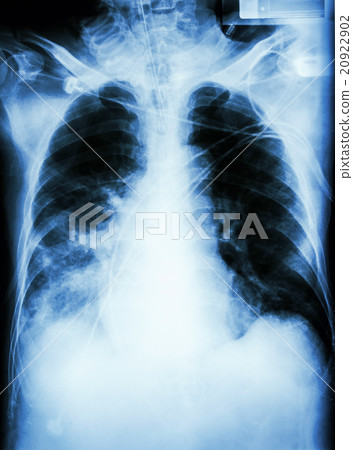 Pneumonia with respiratory failure Pneumonia with respiratory failure 20922902