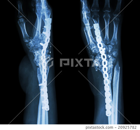 Fracture wrist and chronic infection Fracture wrist and chronic infection 20925782