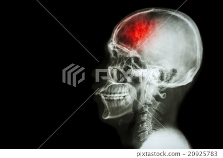 "Stroke" (cerebrovascular accident) "Stroke" (cerebrovascular accident) 20925783