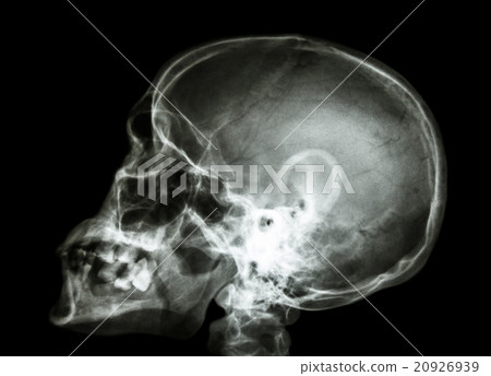 X-ray asian skull and cervical spine X-ray asian skull and cervical spine 20926939