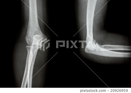 Film X-ray elbow AP(Antero-posterior)/lateral Film X-ray elbow AP(Antero-posterior)/lateral 20926959
