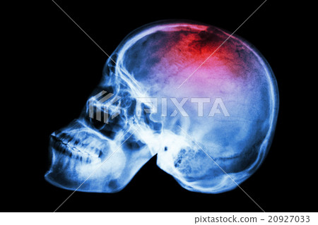 X-ray skull lateral with "Stroke" X-ray skull lateral with "Stroke" 20927033