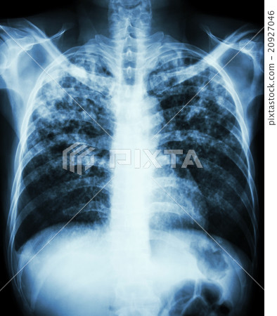 Pulmonary tuberculosis 20927046
