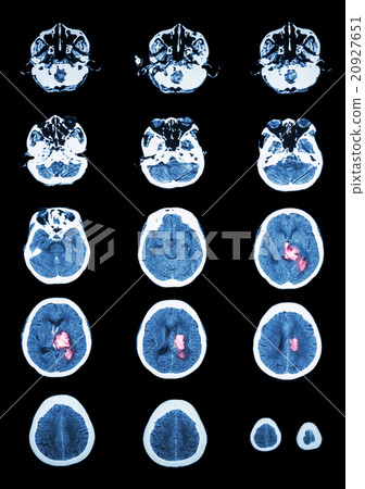 Hemorrhagic Stroke Hemorrhagic Stroke 20927651