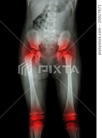 Film x-ray body of child and arthritis 20927671