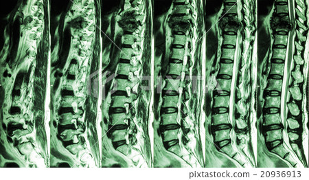MRI of Lumbar & Thoracic spine 20936913