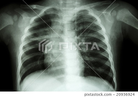 Pulmonary Tuberculosis Pulmonary Tuberculosis 20936924