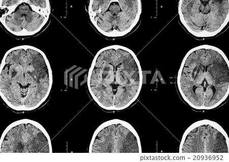 Ischemic stroke 20936952