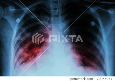 Pulmonary Tuberculosis ( TB ) 20936955