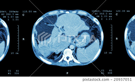 Liver cancer Liver cancer 20937051