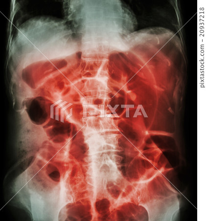 Bowel Obstruction  20937218