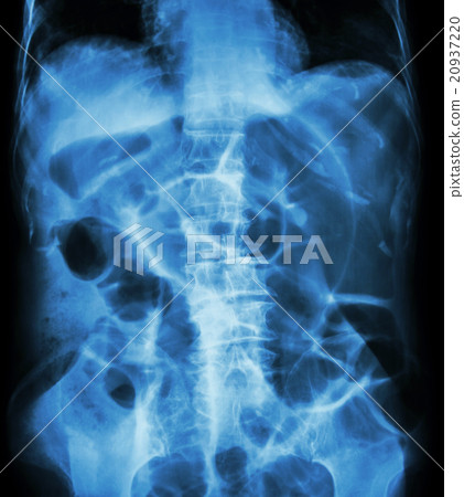 Bowel Obstruction  20937220