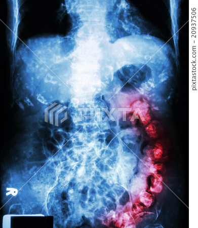 Constipation Constipation 20937506