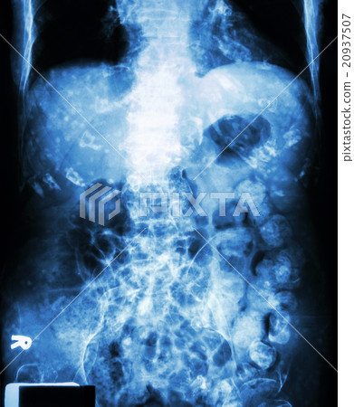 Constipation 20937507