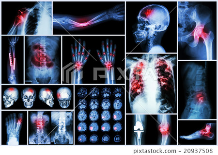 X-ray multiple disease  20937508