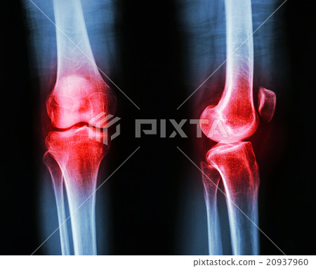 arthritis at knee joint 20937960