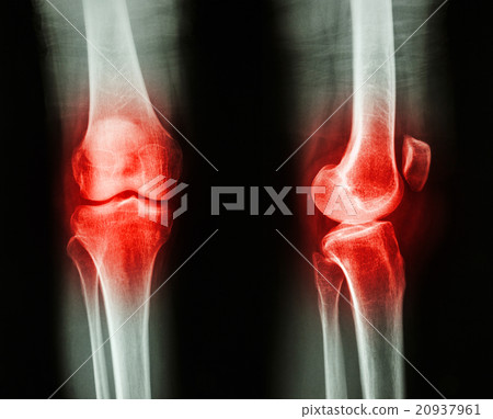 arthritis at knee joint arthritis at knee joint 20937961