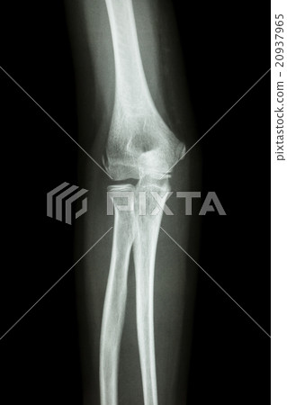 normal elbow 20937965