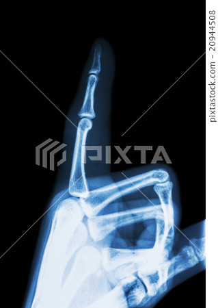 film x-ray index finger and hand( point a finger ) 20944508