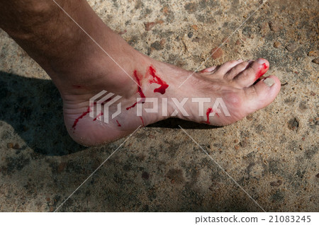 Man's bloody foot 21083245