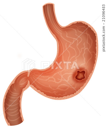 胃潰瘍 胃潰瘍 21096483