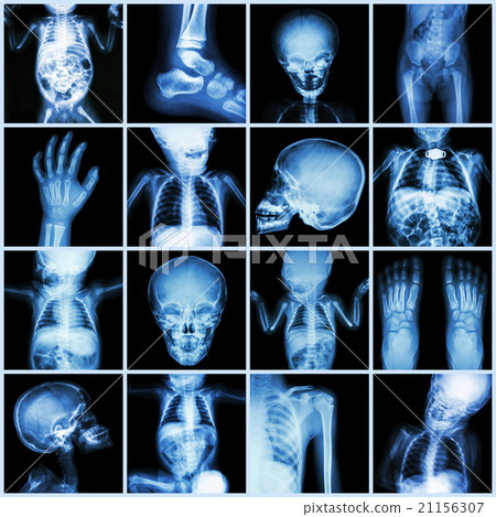 Collection X-ray part of child body 21156307