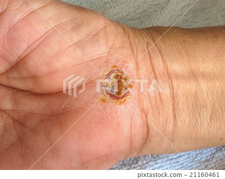 Wound on woman hand 21160461