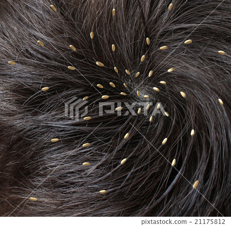 Head Lice 21175812