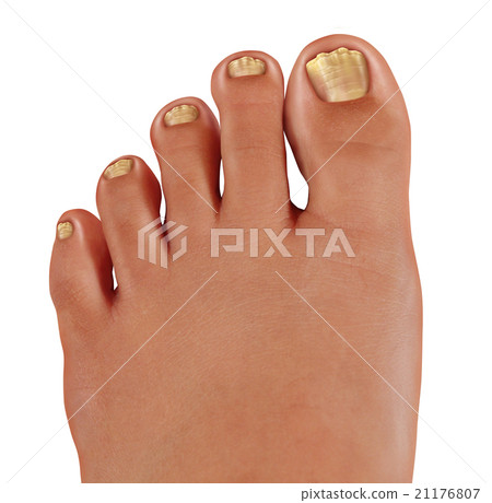 ToeNail Fungus ToeNail Fungus 21176807