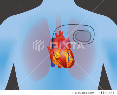 Human heart and pacemaker Human heart and pacemaker 21180821