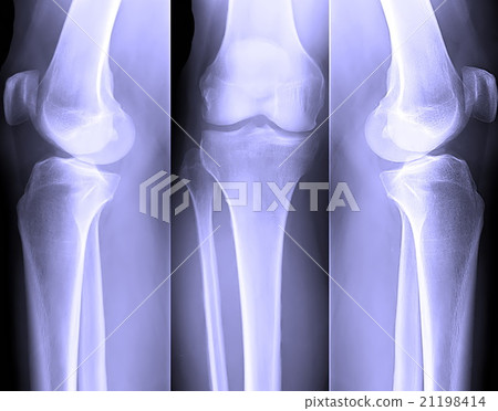 Knee x-ray 21198414