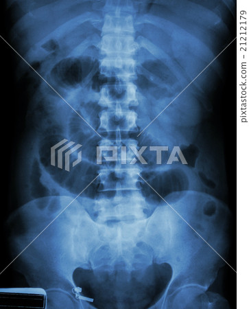 "Small intestine obstruction" "Small intestine obstruction" 21212179
