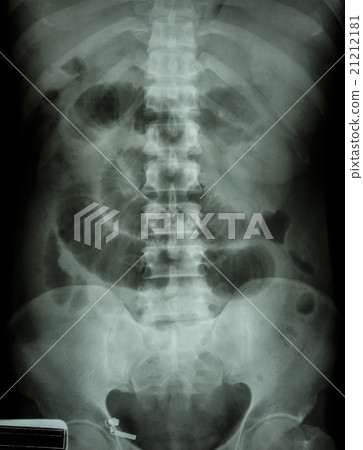"Small intestine obstruction"   21212181
