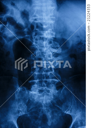 "Spondylosis"  Film x-ray of lumbar spine 21224353