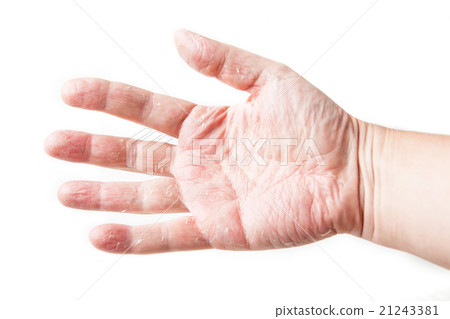 skin disease. Skin Allergy Patch Test on Back of 21243381