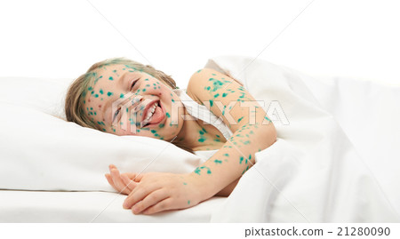 sick child has the virus on skin 21280090