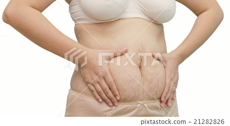 Asian woman showing her stretch marks Asian woman showing her stretch marks 21282826