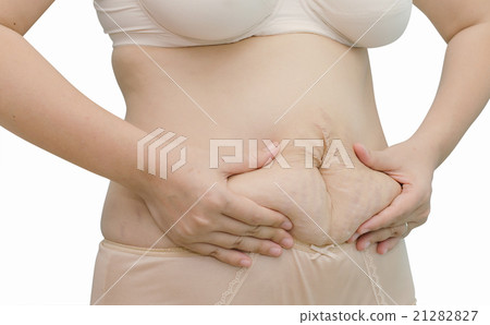 Asian woman showing her stretch marks Asian woman showing her stretch marks 21282827