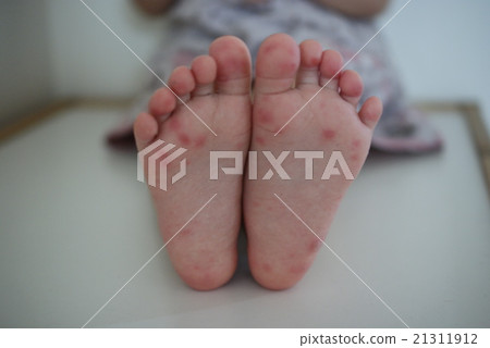 Hand-foot-and-mouth disease  21311912