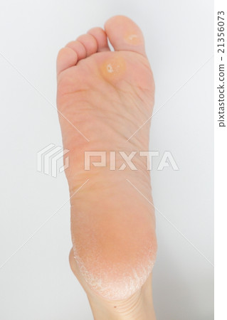 足部護理 21356073