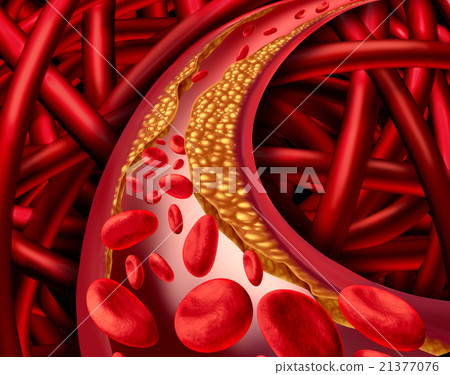 Artery Disease Artery Disease 21377076