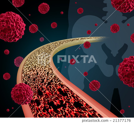 Bone Cancer 21377176