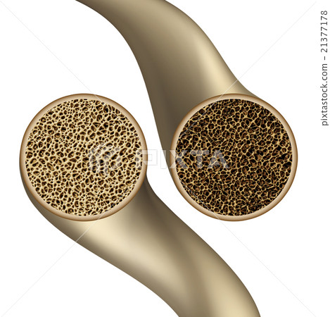 Bone Health Symbol 21377178