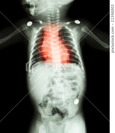Congenital Heart Disease , Rheumatic Heart Disease Congenital Heart Disease , Rheumatic Heart Disease 21398803