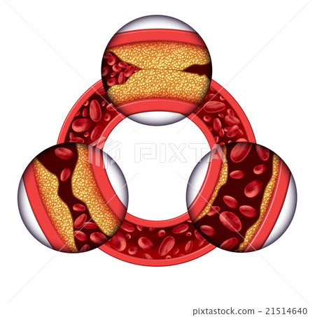 Coronary Artery Disease Coronary Artery Disease 21514640