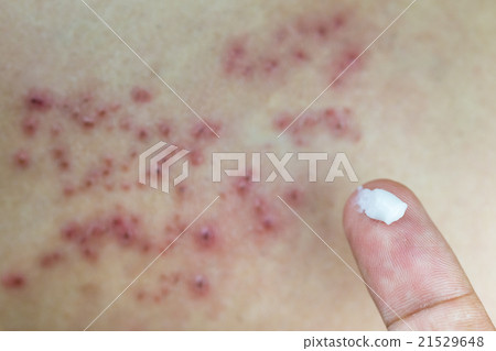 Raised red bumps and blisters on skin Raised red bumps and blisters on skin 21529648