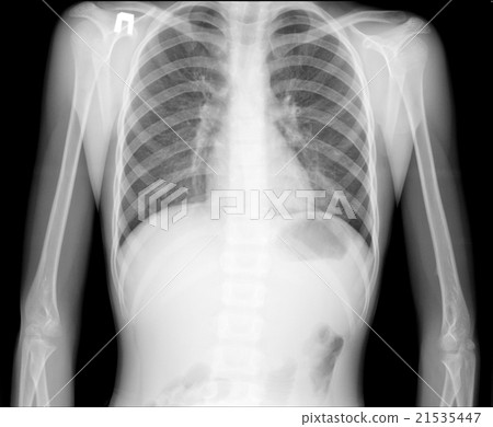X-ray of human chest 21535447