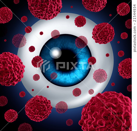 Eye Cancer 21544934